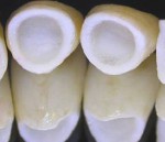 prótesis dental