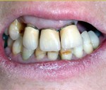 prótesis dental madrid