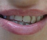 prótesis dentales fijas