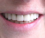 prótesis dental chamartín