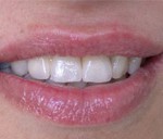 prótesis dental antes después
